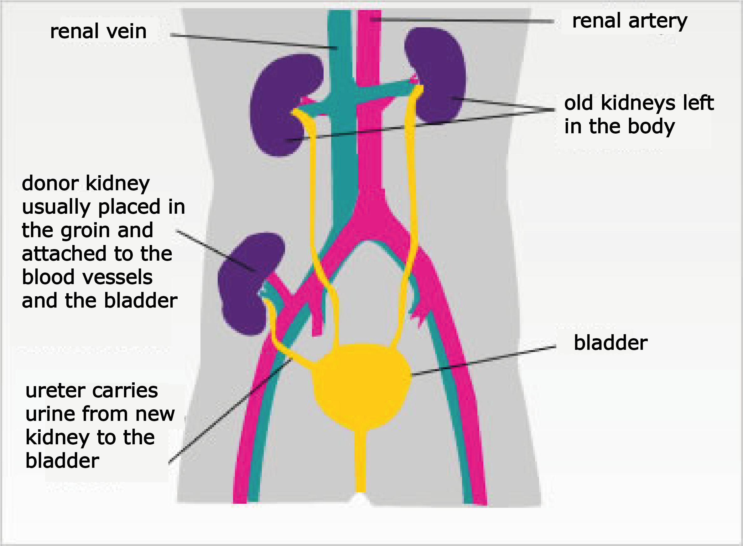 New Kidney Transplant