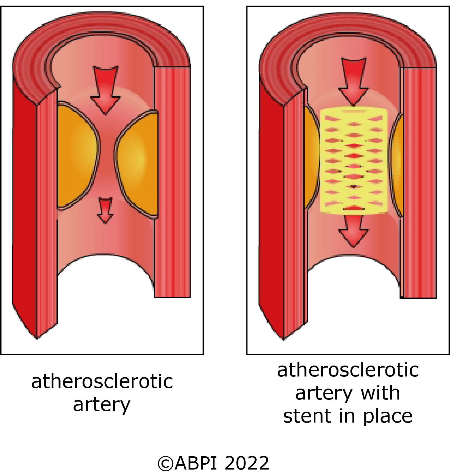 Atherosclerosis Stents