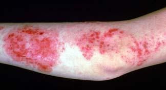 Skin Infections 2