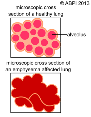 The difference in surface area between normal alveoli and lungs affected by emphysema causes many problems for affected people.