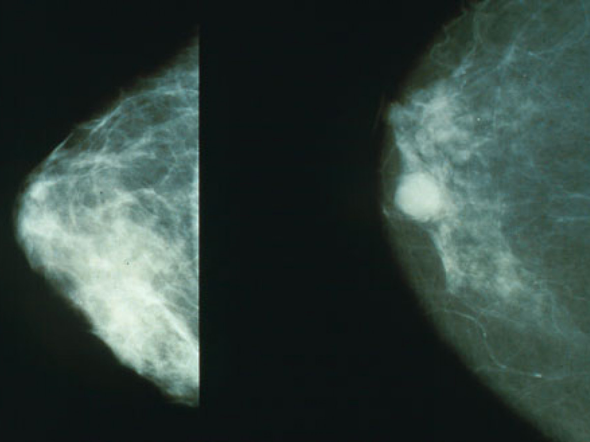 Mammograms