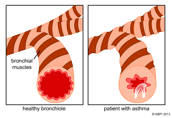 Contraction Of Bronch Muscles