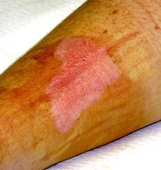 Skin Injuries 1