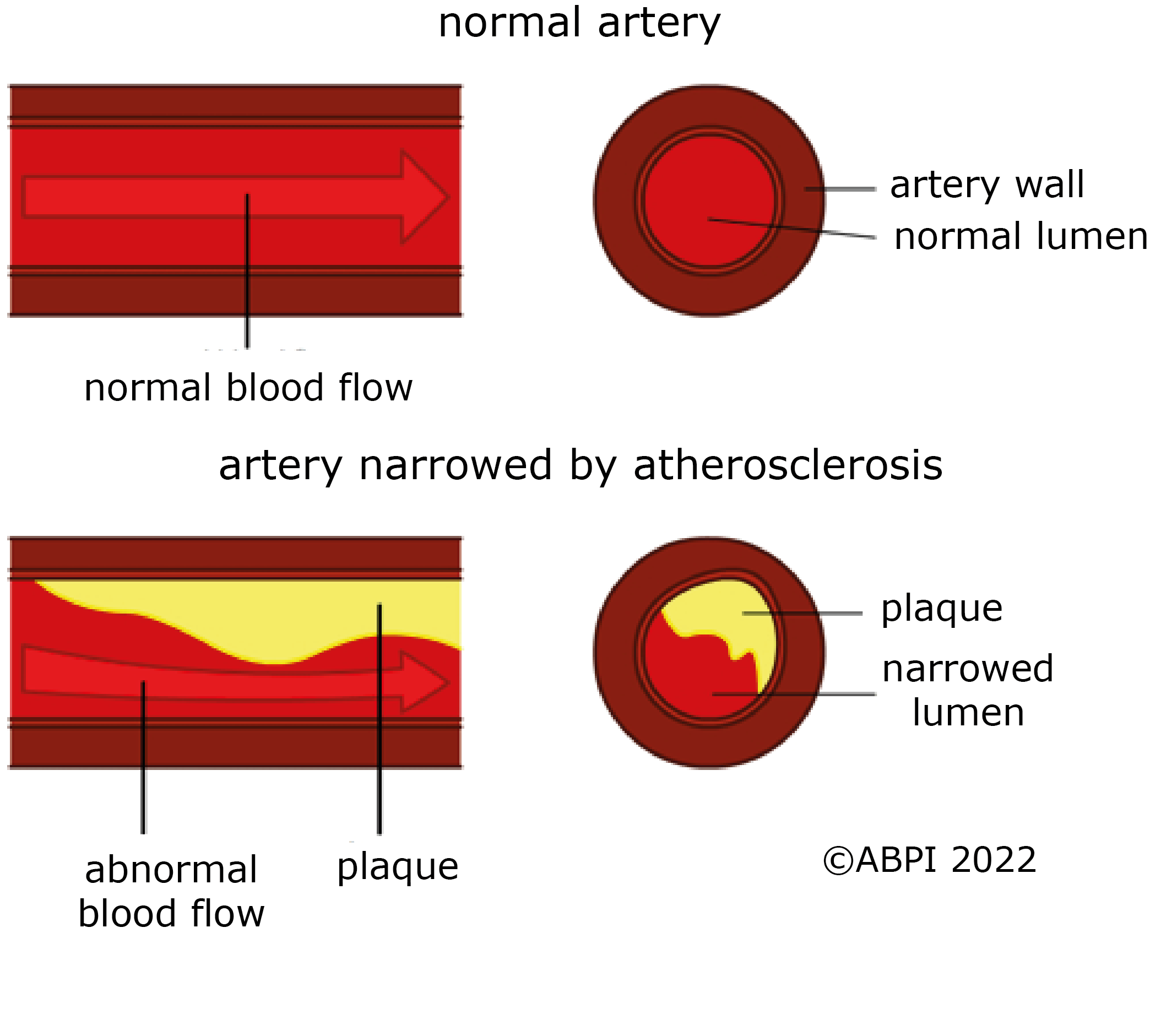 Atherosclerosis New
