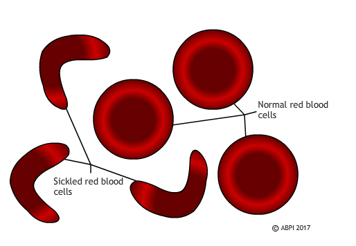 Sickled red blood cells don’t carry oxygen effectively and block blood vessels causing pain and tissue death. Genetic modification of the blood stem cells may eventually make this disease a thing of the past.
