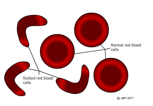 Sickle RBC