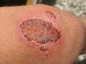 Scarring is the result of rapid mitosis to heal a wound (Photo credit: ALEF7. Licensed under the Creative Commons Attribution-Share Alike 3.0 Unported license)